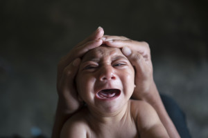 AP Photo A baby in Brazil with microcephaly.